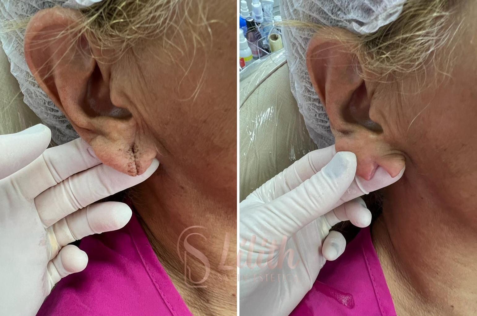 Lobuloplastia